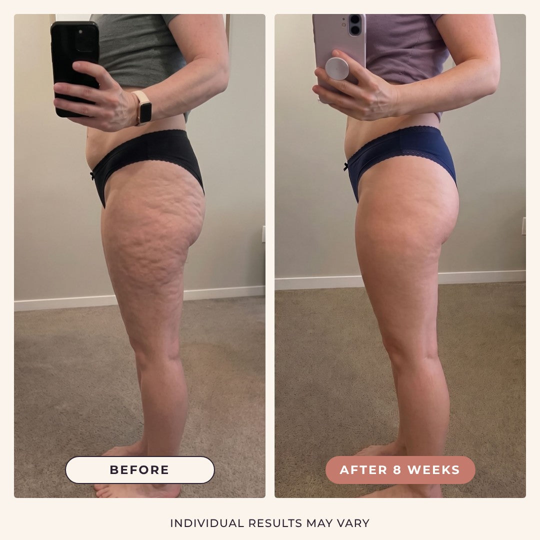 Cellulite before and after 8 weeks